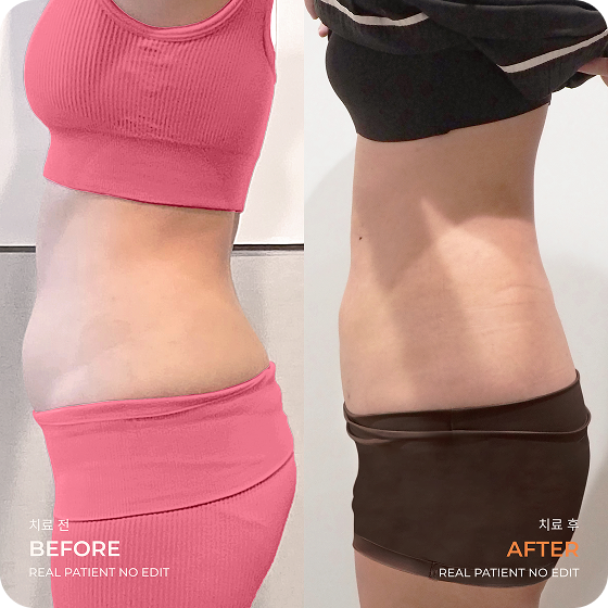 Before After LAMS Postpartum Mom