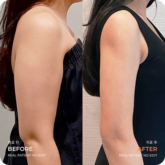 Before After LAMS Lengan Atas