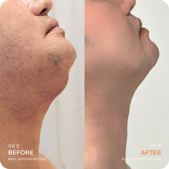 Before After LAMS Double Chin