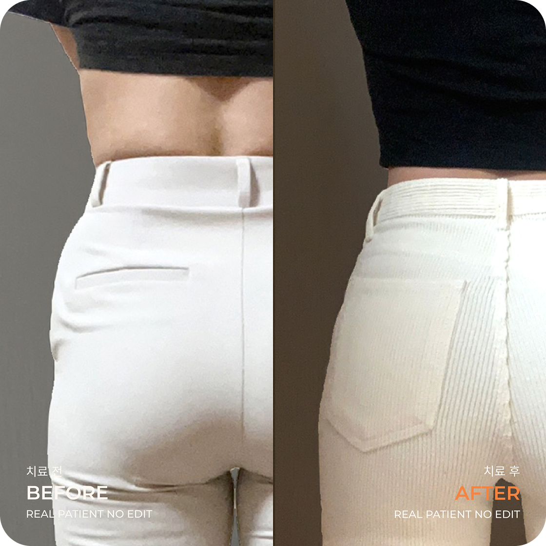Before After LAMS Pinggang Samping